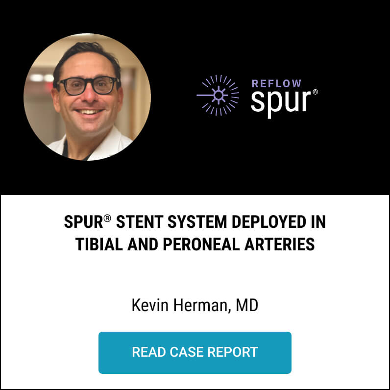 Spur Stent System Deployed in Tibial and Peroneal Arteries
